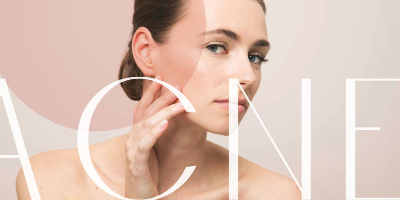 Acne en andere puistjes, hoe behandel je die?