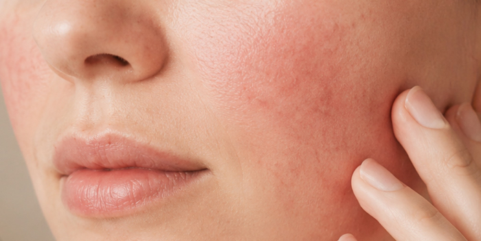 Rosacea & voeding: wat kan je eten en wat laat je liever staan?
