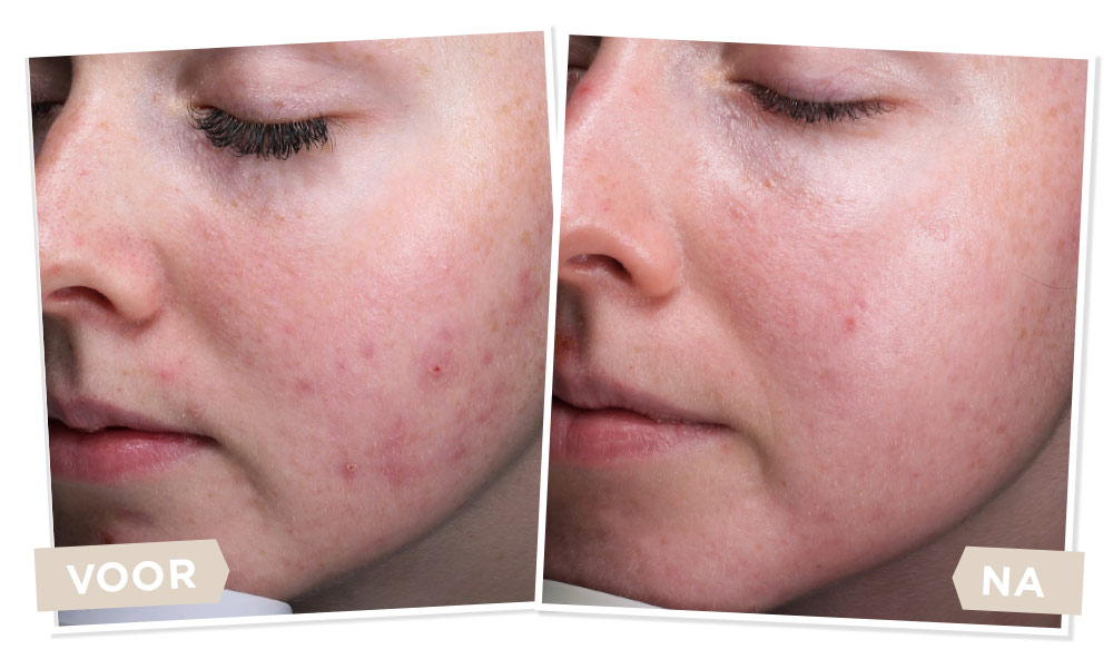 Before en after Fleur