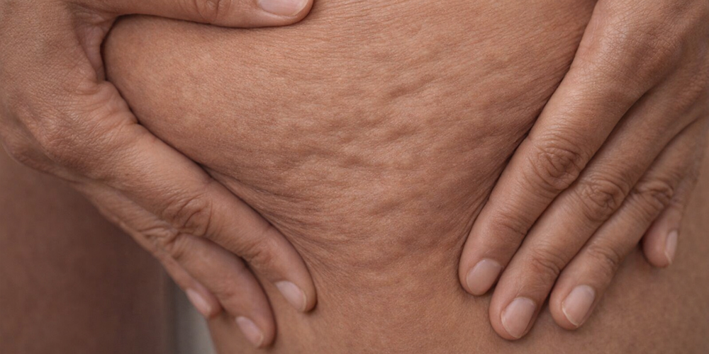 Wat helpt écht tegen cellulite?